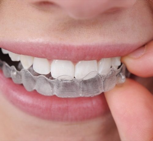 Invisalign & Teeth straightening clear Aligners