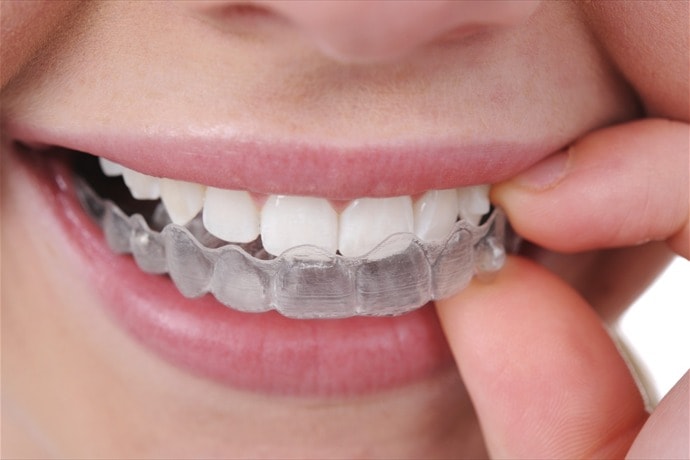Invisible Braces Cost In Pune