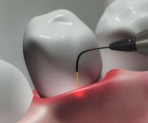 Dental lasers at Smilex