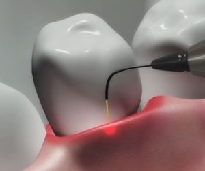 Dental lasers