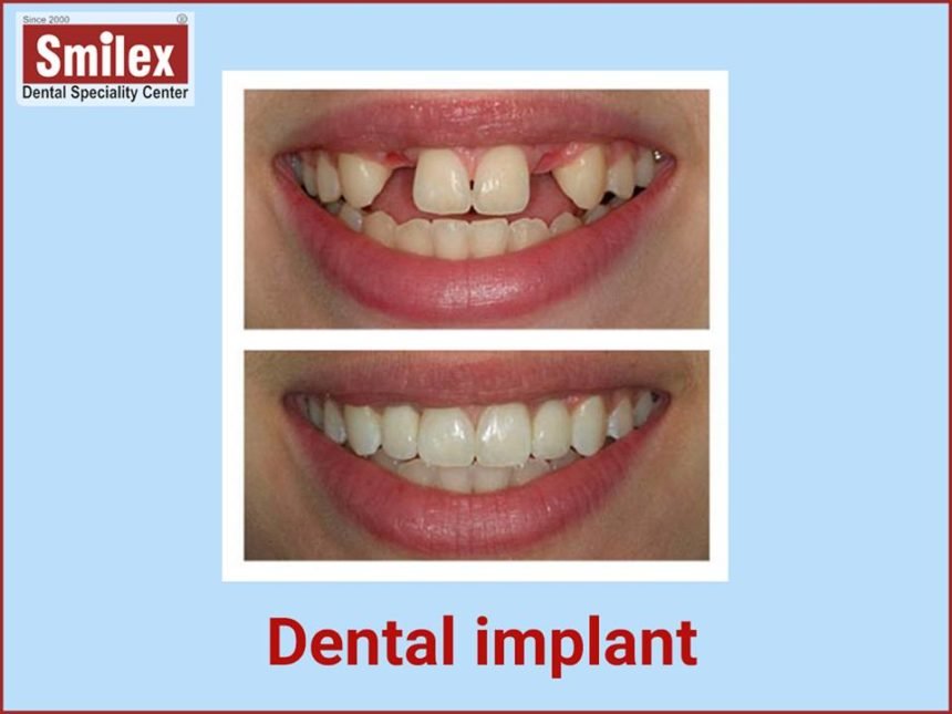 Dental Implants will make you healthy