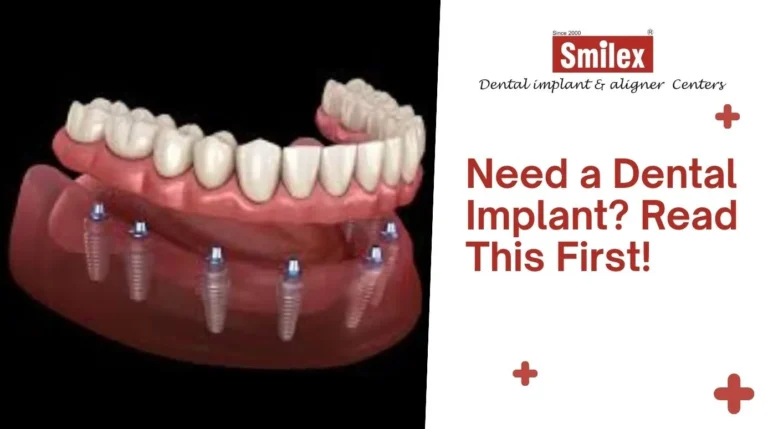 Dental Implants