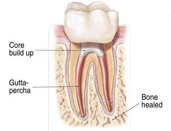Root Canal at Smilex