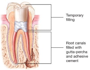 Root Canal Treatment With Rotary Instrument