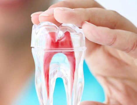 Root Canal Treatment in Pune – Smilex