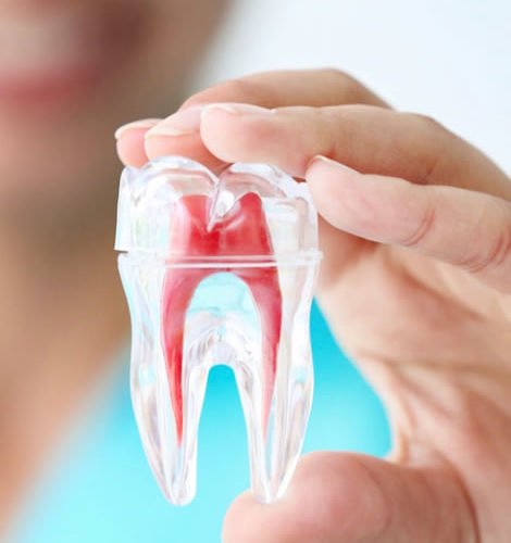 Root Canal Treatment in Pune – Smilex