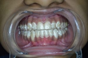 Fixed Invisalign Invisible Braces in Pune