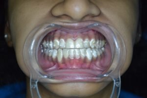 Fixed inside Invisalign Invisible Braces in Pune
