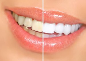 Teeth Whitening at Smilex
