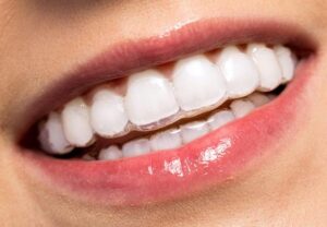Invisalign for teeth straightening