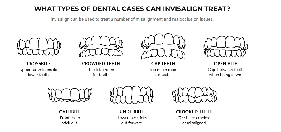 Dental Cases types for Invisalign treatment
