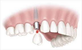 Single Tooth  Implants
