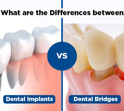 What are the differences between dental implants and bridges?