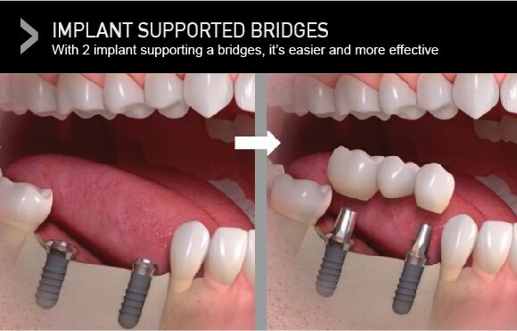  Implant supported dental bridges