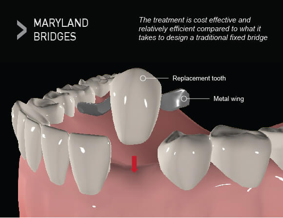  Maryland Dental bridges
