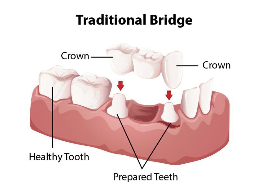  Traditional Dental Bridges types