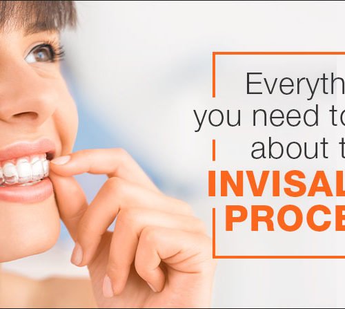 Everything you need to know about the Invisalign process