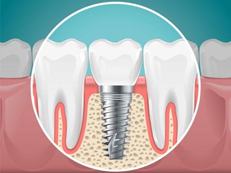 dental implants in pune
