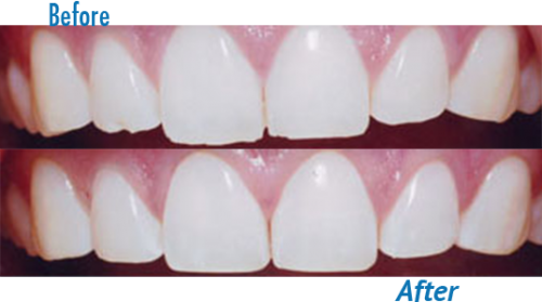 Teeth Reshaping