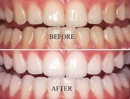teeth whitening effects