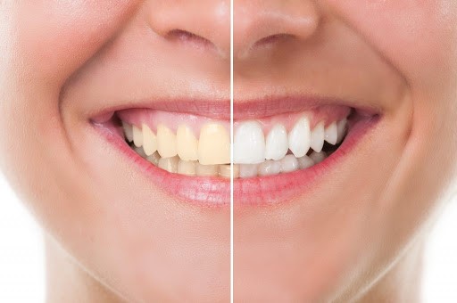 How to improve your teeth?