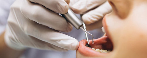 root canal treatment in pune provided by Smilex