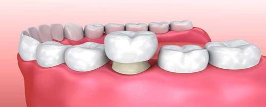 dental implants at Smilex