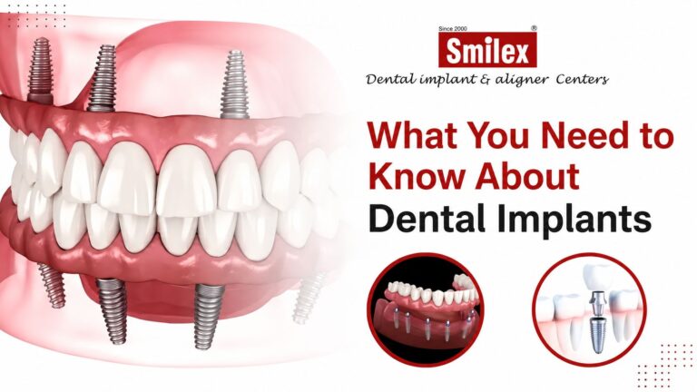 Dental Implants
