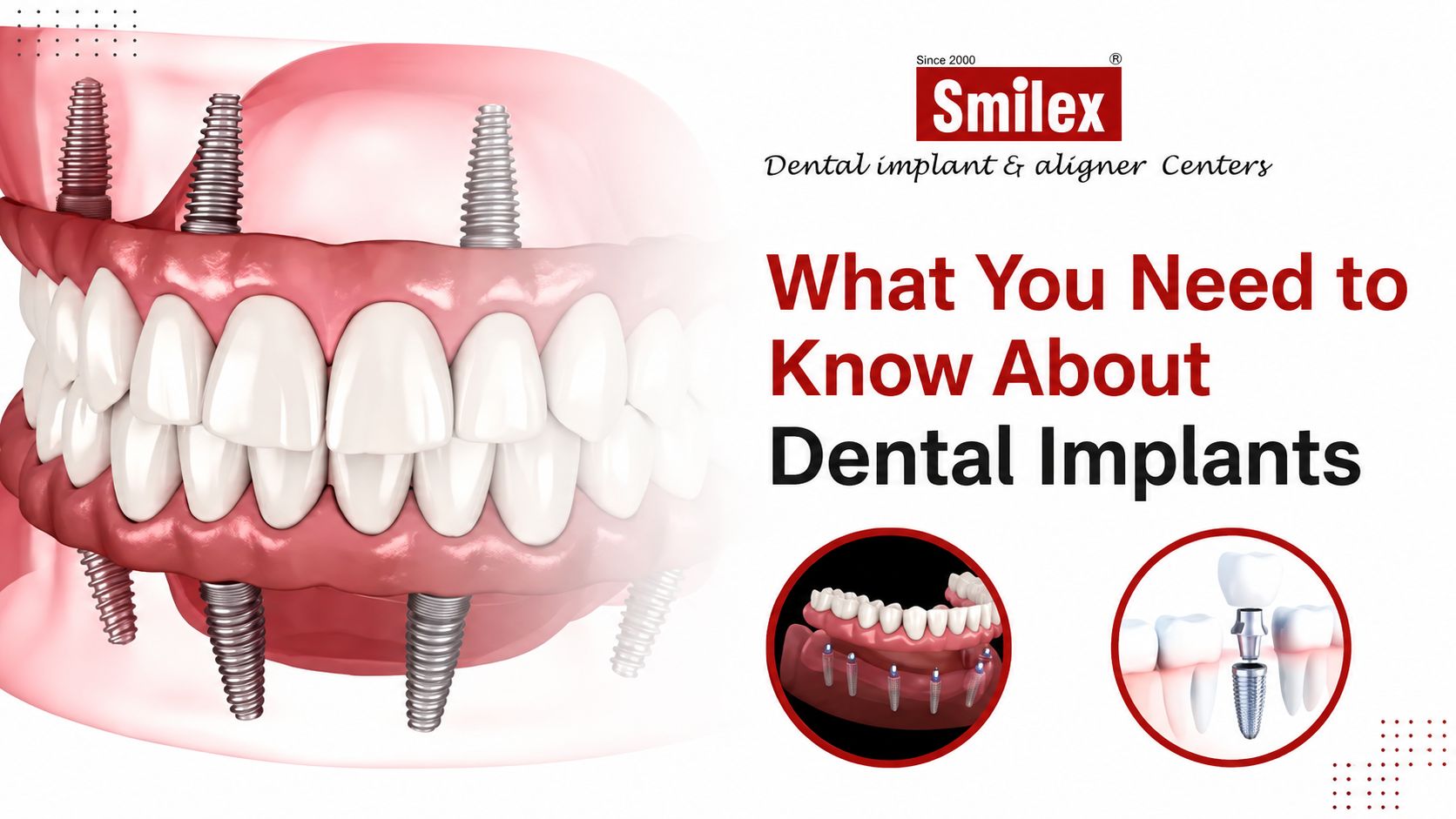 Dental Implants