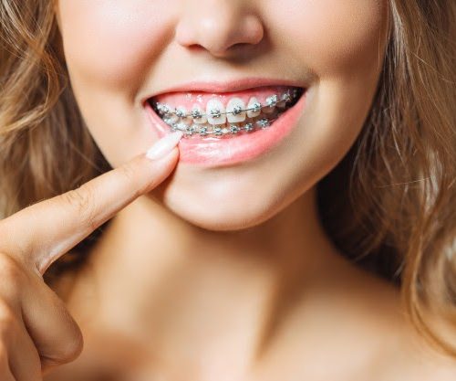 Preparing for your Braces Journey