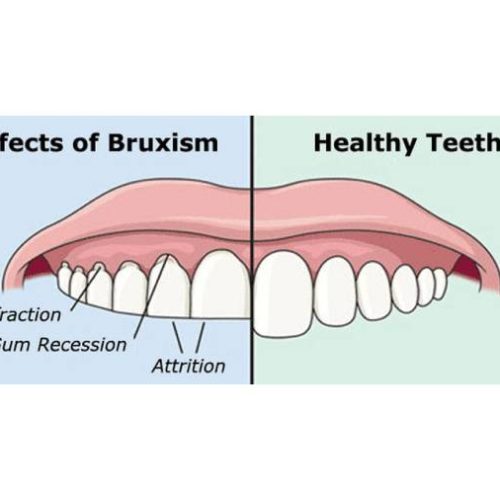 Bruxism/ Teeth Grinding- Find out how Braces or Clear Aligners help with Teeth Grinding?