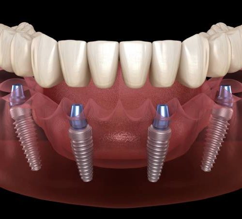 All-on-4 Dental Implants! Know Why They Are Better Option Than Dentures?