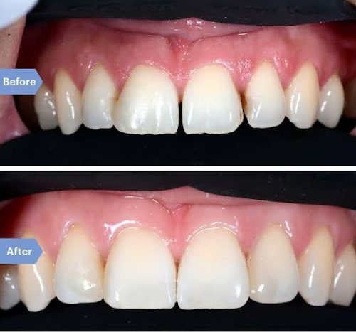 How is a Smile Makeover Done?