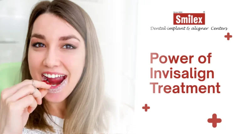 Invisalign