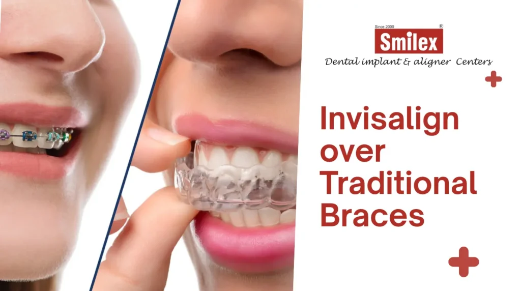 eating drinking with invisalign 4 (4)