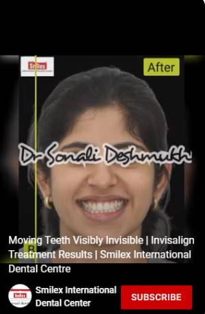 Clear Aligners Visibly Invisible Moving Teeth Image 2