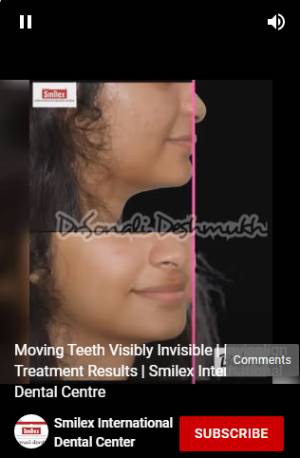 Invisible Braces cost in Pune Image 1