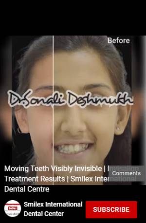 Invisible Braces cost in Pune Image 2