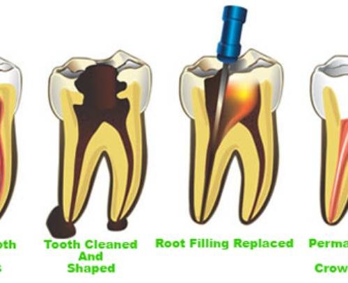 Why Is Root Canal Treatment Important And How Is It Done?