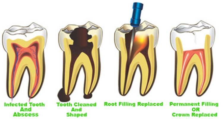 Best Root canal treatment and procedure - Smilex