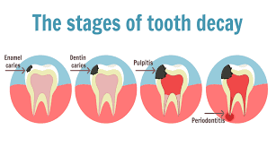 Different Stages of tooth decay