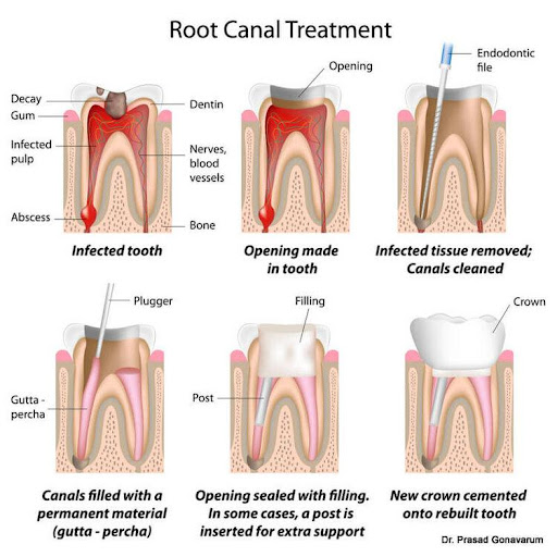 Procedure for root canal treatment