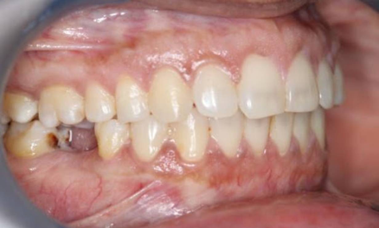 Teeth braces cost in pune