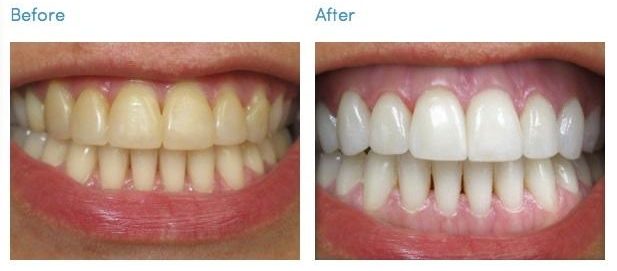 Before and After Teeth whitening-smilex
