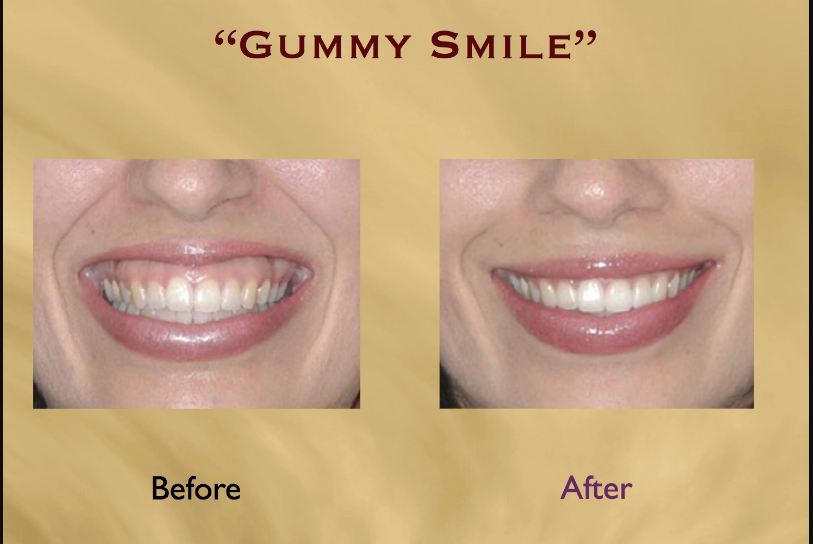 Before and After Gummy Smile makeover
