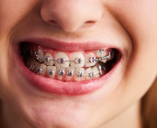 Does Orthodontic Treatment Help In Gummy Smiles