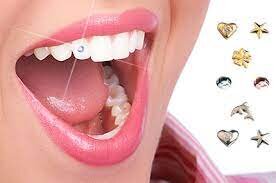 Dental Jewellery Treatment