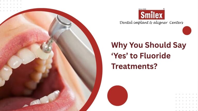 Fluoride Treatments