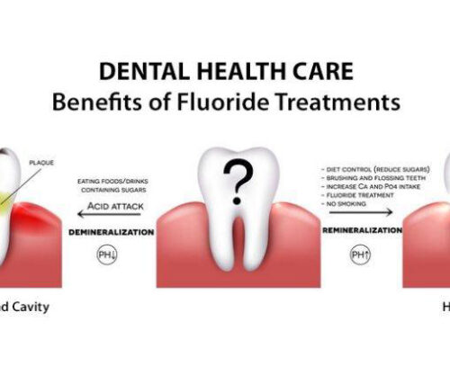 Why you should say ‘yes’ to fluoride treatments?