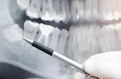 Affordable X-rays at best dental clinic in Pune